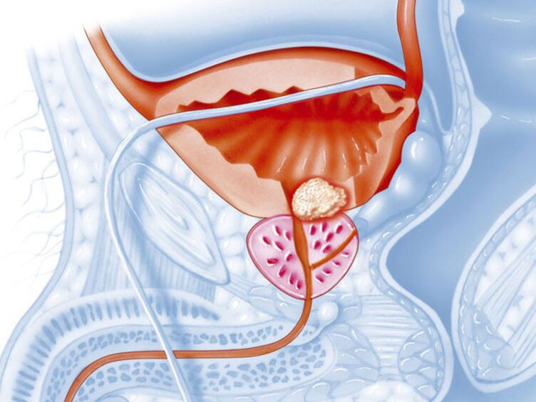 síntomas de prostatite crónica