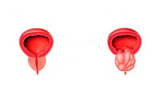 próstata sa e inflamada con prostatite